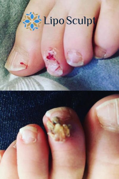 Wart removal customer results from Lipo Sculpt Coatbridge